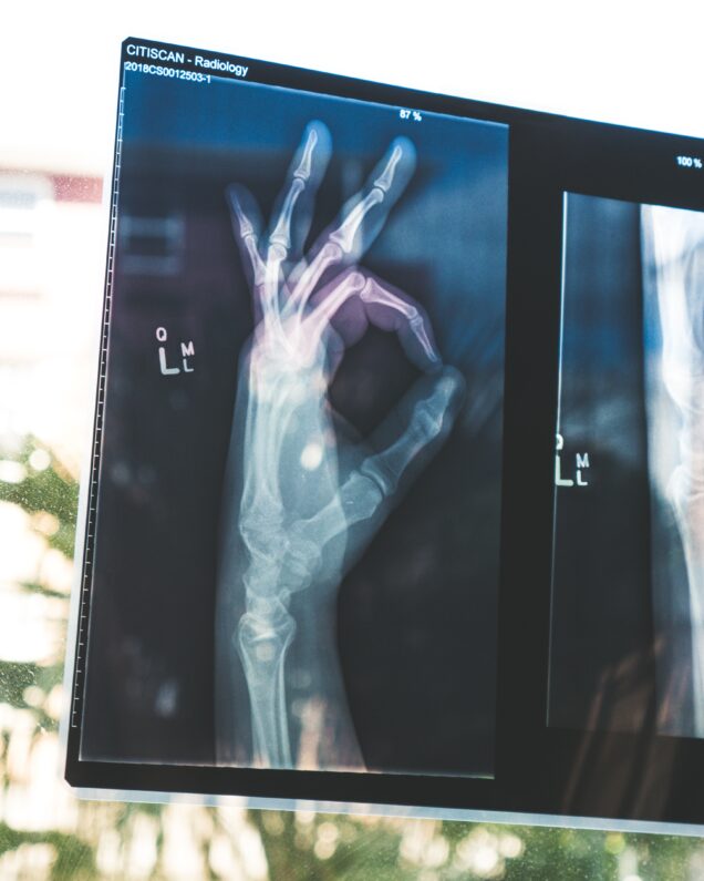 X-ray of hand giving the Okay sign